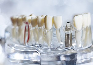 a model of a mouth showing how a dental implant works